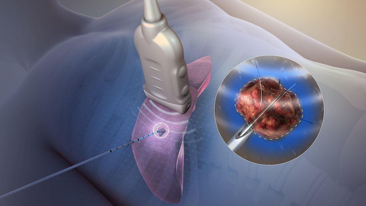 Radiofrequency Ablation Explained