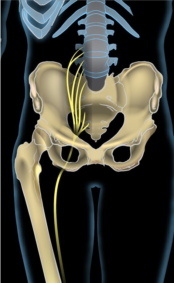 Sciatica — When to See a Specialist