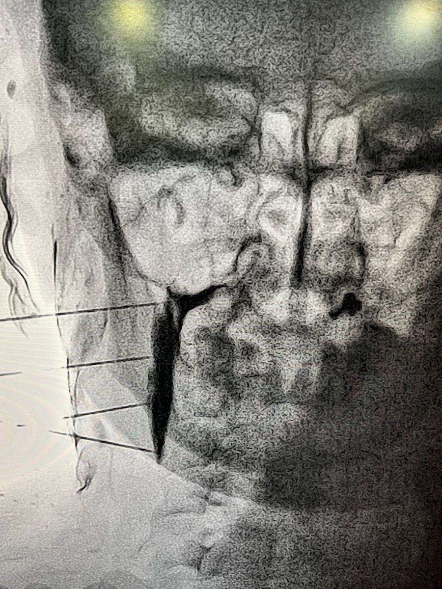 Cervical Facet Block procedure