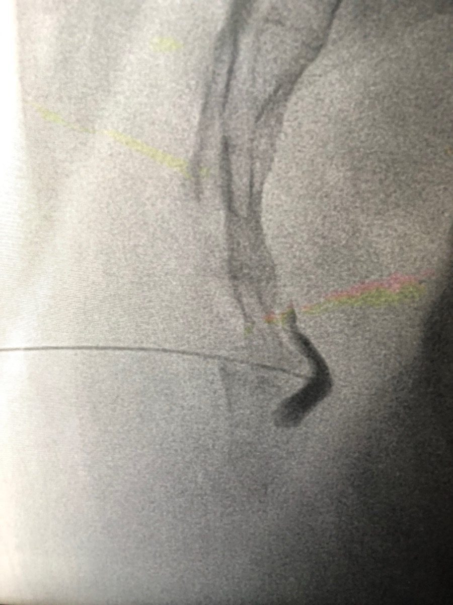 Ganglion Impar Block and RFA procedure