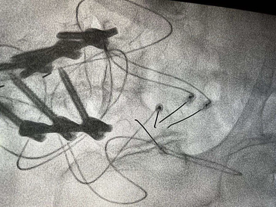 Sacroiliac Joint RFA procedure