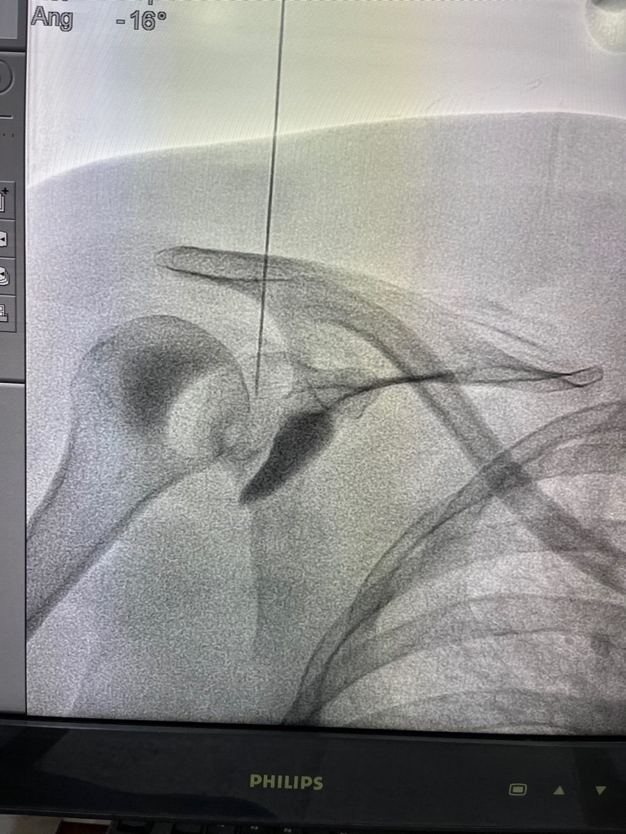 Shoulder Joint RFA and Frozen Shoulder Release procedure