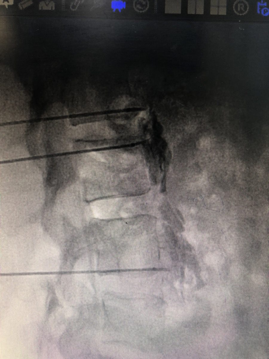 Doctor performing a sympathetic nerve block procedure for vascular pain