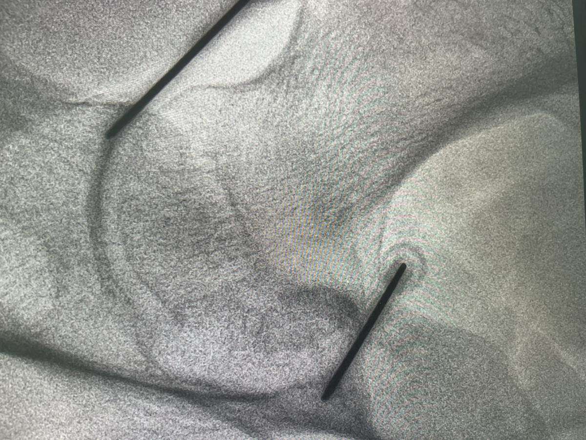 Doctor performing a hip injection procedure