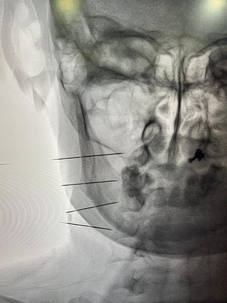 Doctor performing a cervical injection procedure