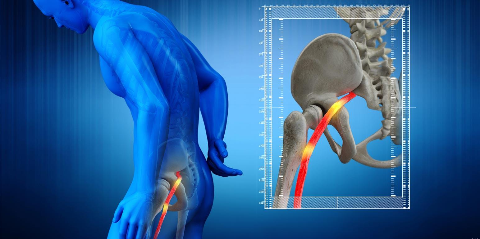 Spine illustration showing sciatic nerve
